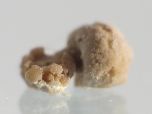 إزالة حصوة الكلية 14 ملم - علاج حصوة الكلية 14 ملم - تفتيت حصوة الكلية 14 ملم - علاج حصوة الحالب 14 ملم - علاج حصوة المثانة 14 ملم